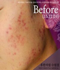 치료 전