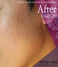 치료 후