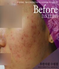 치료 전