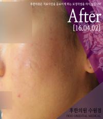 치료 후