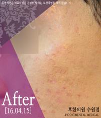 치료 후