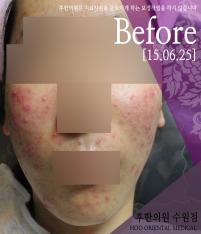 치료 전