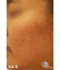 치료 후