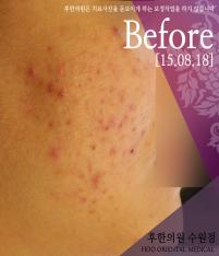 치료 전