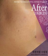 치료 후