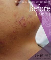 치료 전