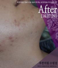 치료 후