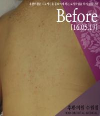 치료 전