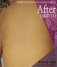 치료 후
