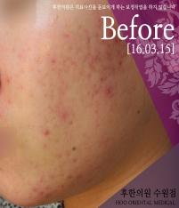 치료 전