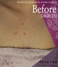 치료 전