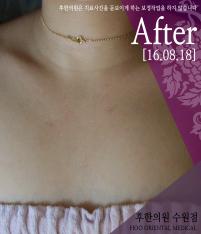 치료 후
