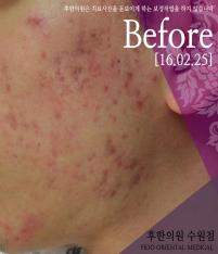 치료 전