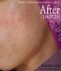 치료 후