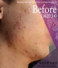 치료 전