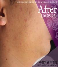 치료 후
