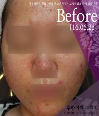 치료 전