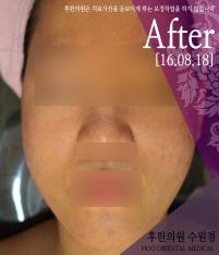 치료 후