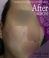 치료 후