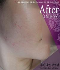 치료 후