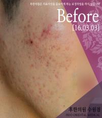 치료 전