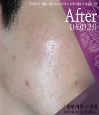치료 후