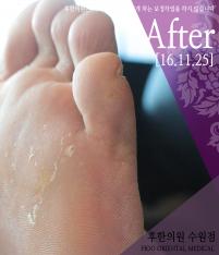 치료 후