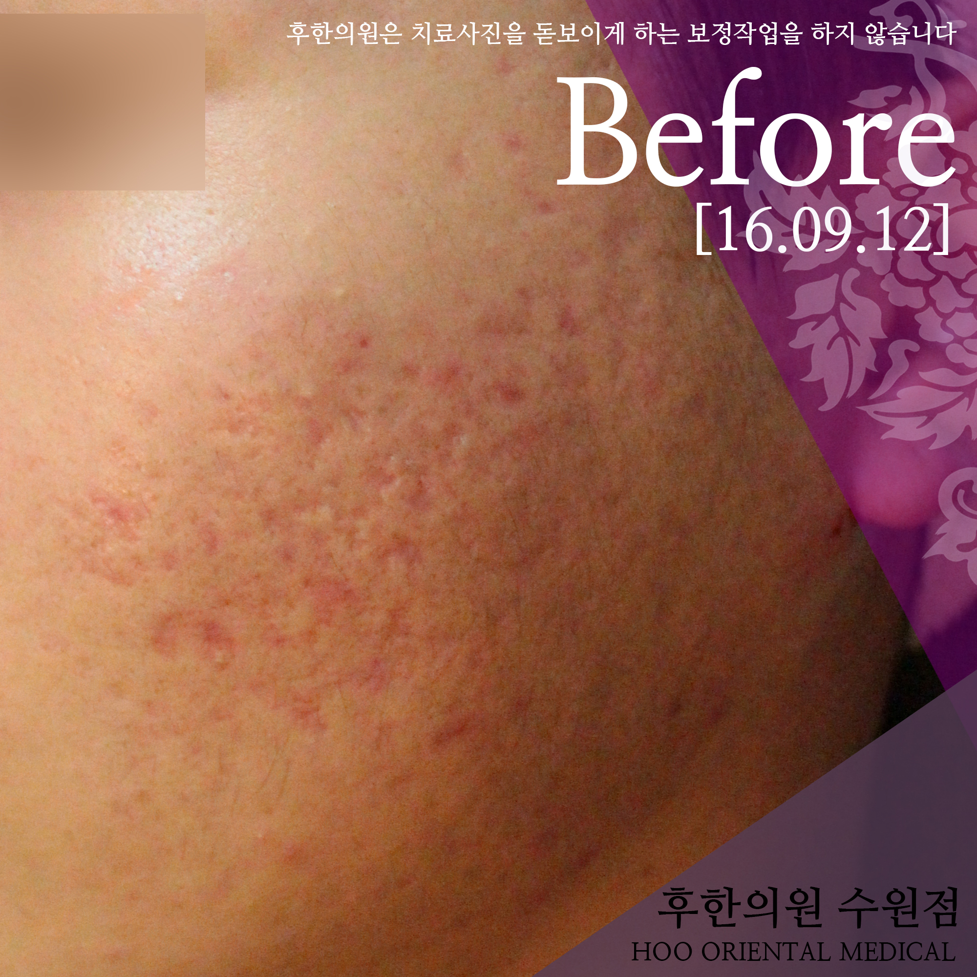 치료 전