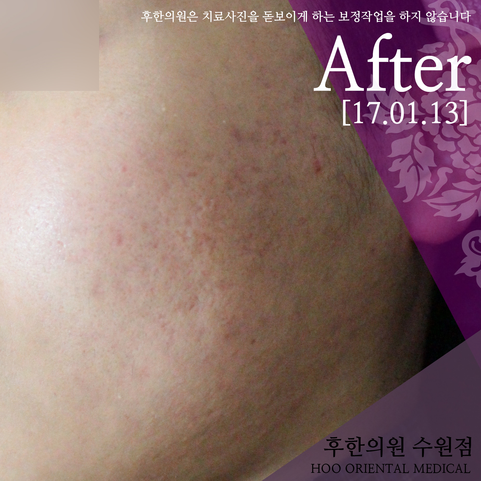 치료 후