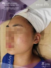 치료 후