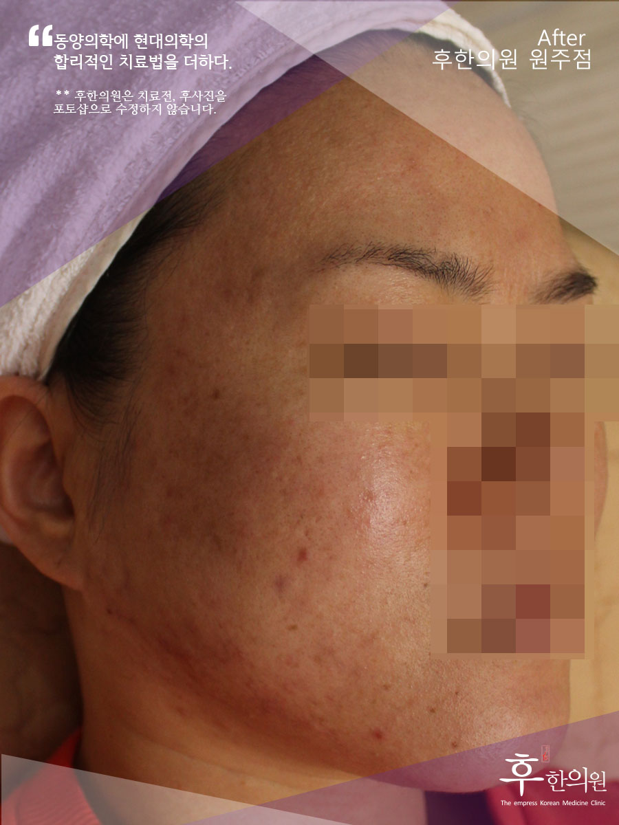 치료 후