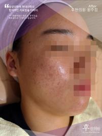 치료 후