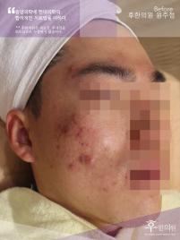 치료 전