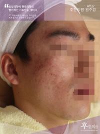 치료 후