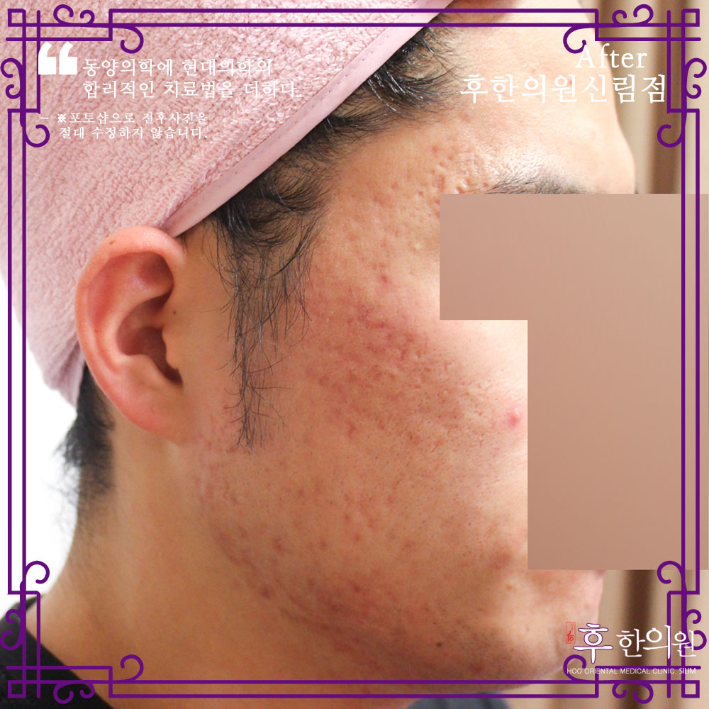 치료 후