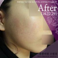 치료 후