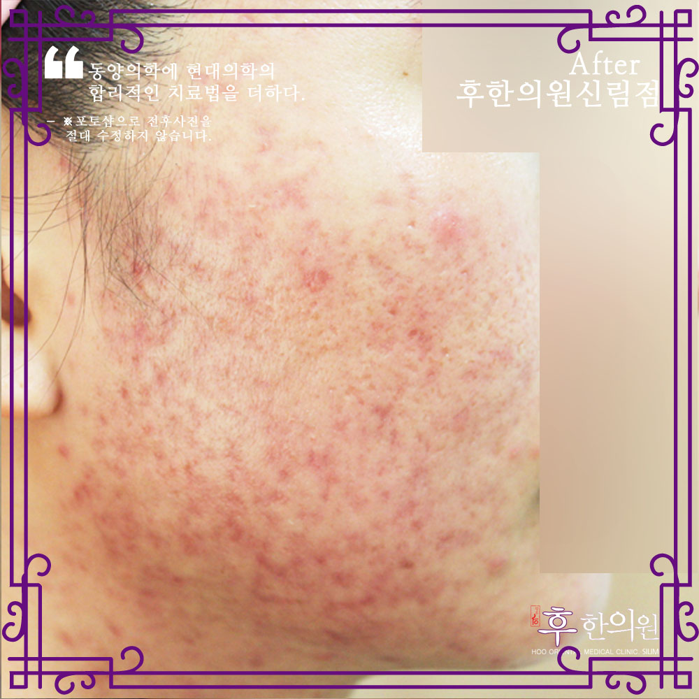 치료 후