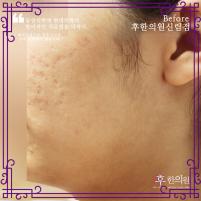 치료 전