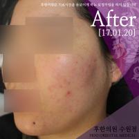 치료 후
