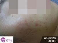 치료 후