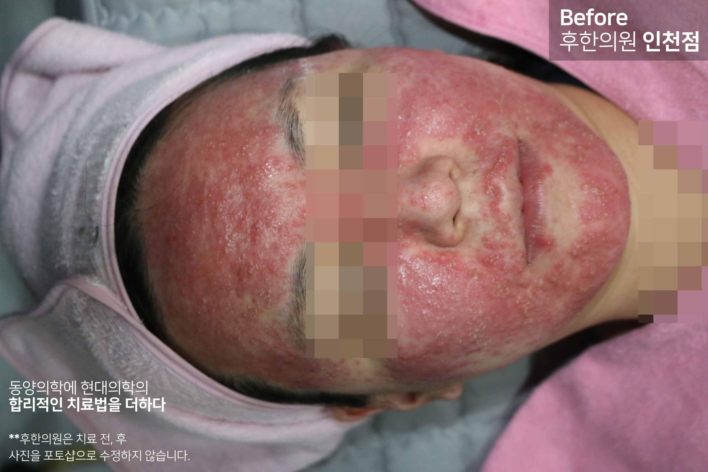치료 전