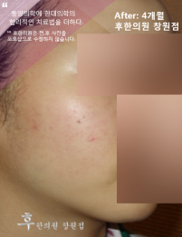 치료 후
