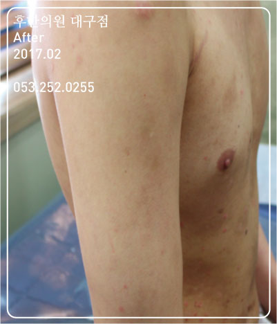 치료 후