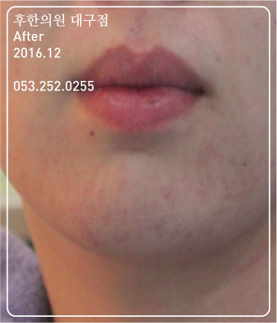 치료 후