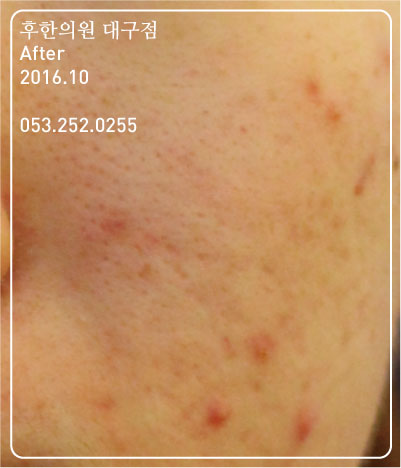 치료 후