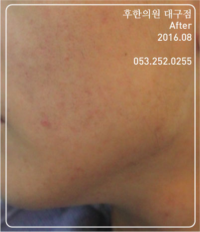 치료 후