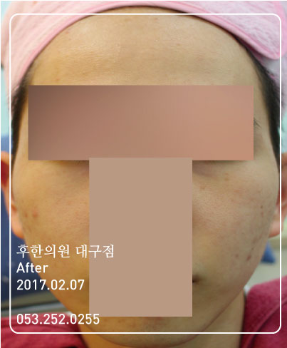 치료 후