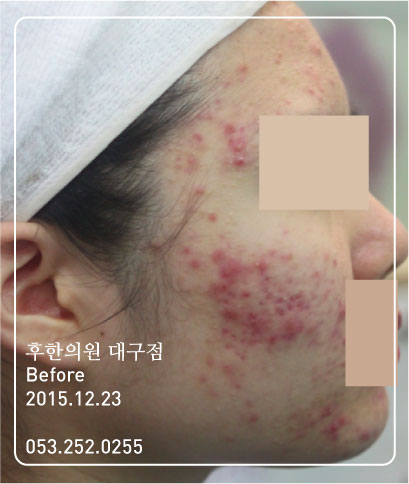 치료 전