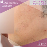 치료 후