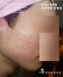 치료 후
